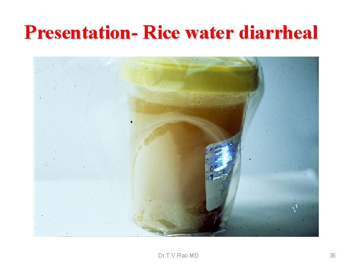 Presentation- Rice water diarrheal Dr. T. V. Rao MD 36 