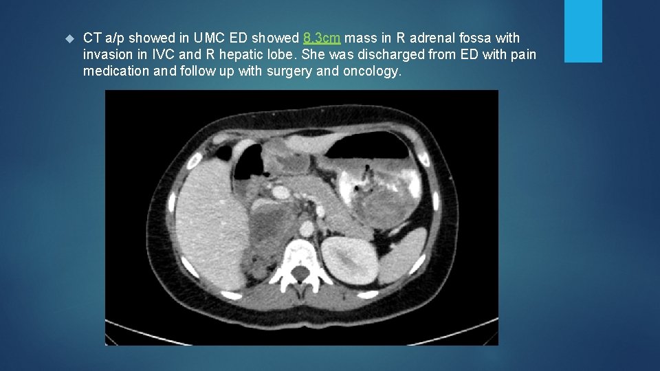  CT a/p showed in UMC ED showed 8. 3 cm mass in R