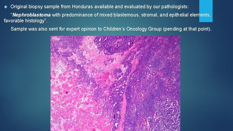  Original biopsy sample from Honduras available and evaluated by our pathologists: “Nephroblastoma with