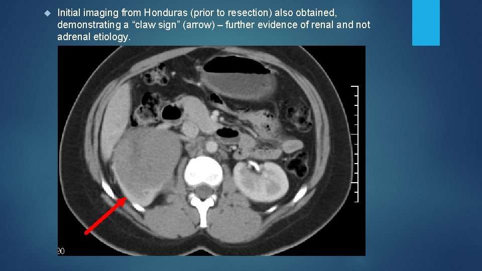  Initial imaging from Honduras (prior to resection) also obtained, demonstrating a “claw sign”