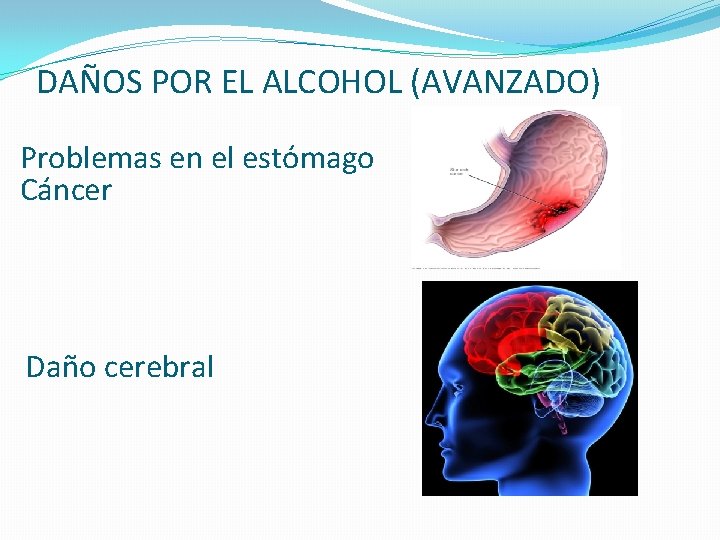DAÑOS POR EL ALCOHOL (AVANZADO) Problemas en el estómago Cáncer Daño cerebral 