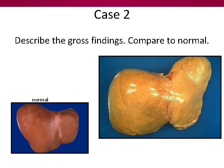 Case 2 Describe the gross findings. Compare to normal 
