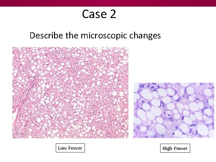 Case 2 Describe the microscopic changes Low Power High Power 