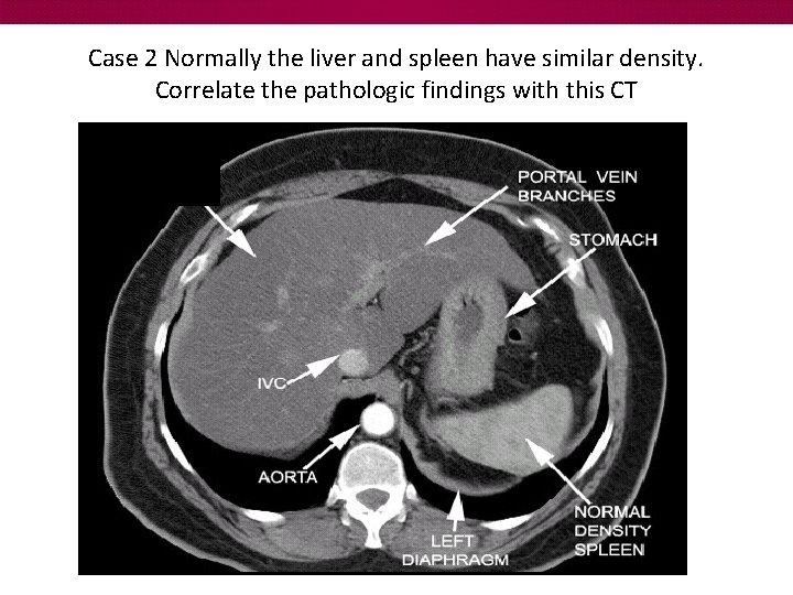 Case 2 Normally the liver and spleen have similar density. Correlate the pathologic findings