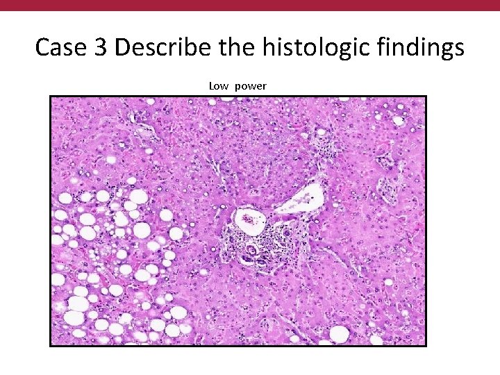 Case 3 Describe the histologic findings Low power 