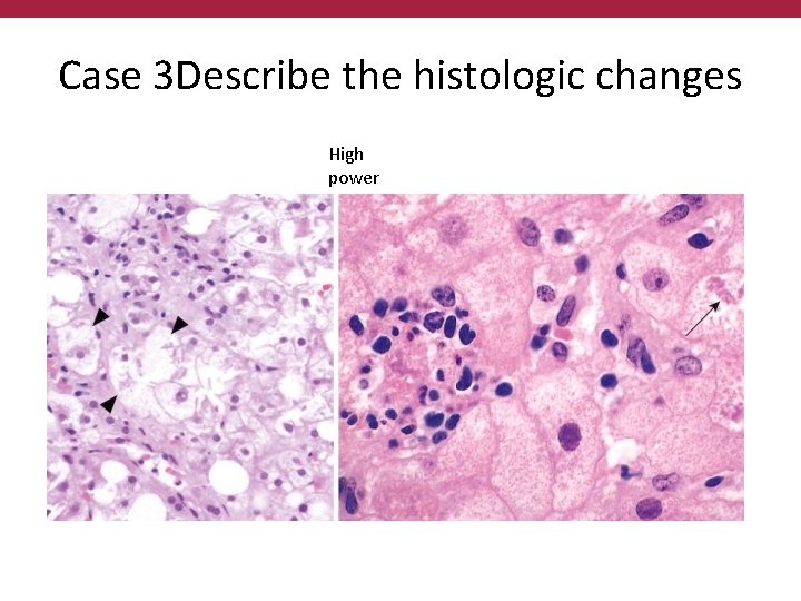 Case 3 Describe the histologic changes High power 