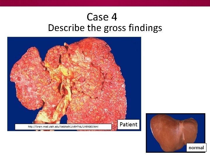Case 4 Describe the gross findings normal 