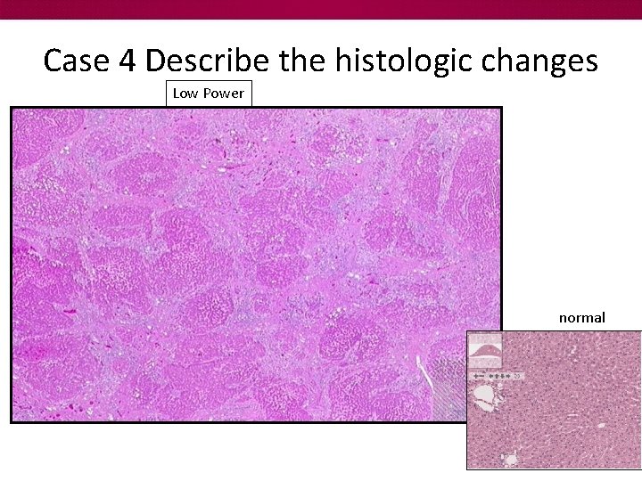 Case 4 Describe the histologic changes Low Power normal 