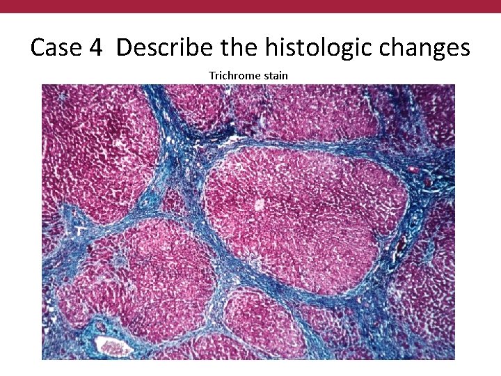 Case 4 Describe the histologic changes Trichrome stain 