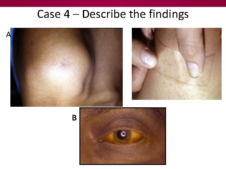 Case 4 – Describe the findings A B 