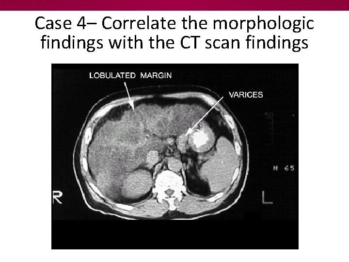 Case 4– Correlate the morphologic findings with the CT scan findings 