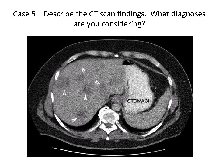 Case 5 – Describe the CT scan findings. What diagnoses are you considering? 