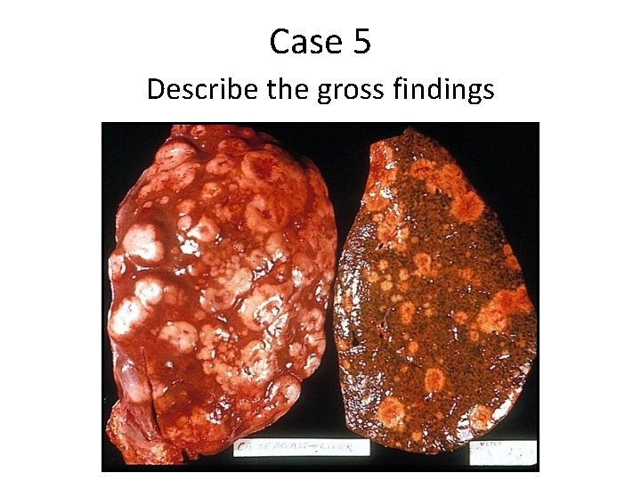 Case 5 Describe the gross findings 