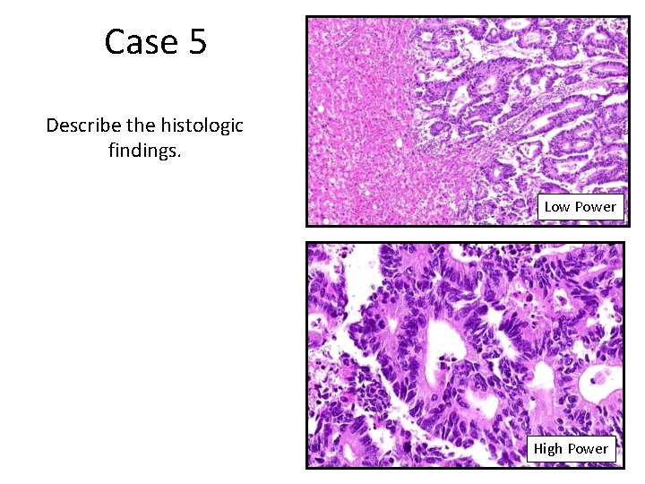 Case 5 Describe the histologic findings. Low Power High Power 