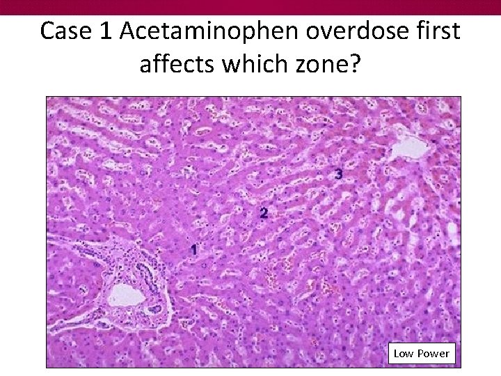 Case 1 Acetaminophen overdose first affects which zone? Low Power 