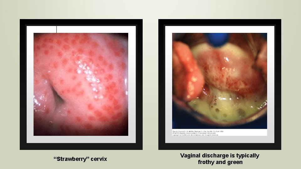 “Strawberry” cervix Vaginal discharge is typically frothy and green 