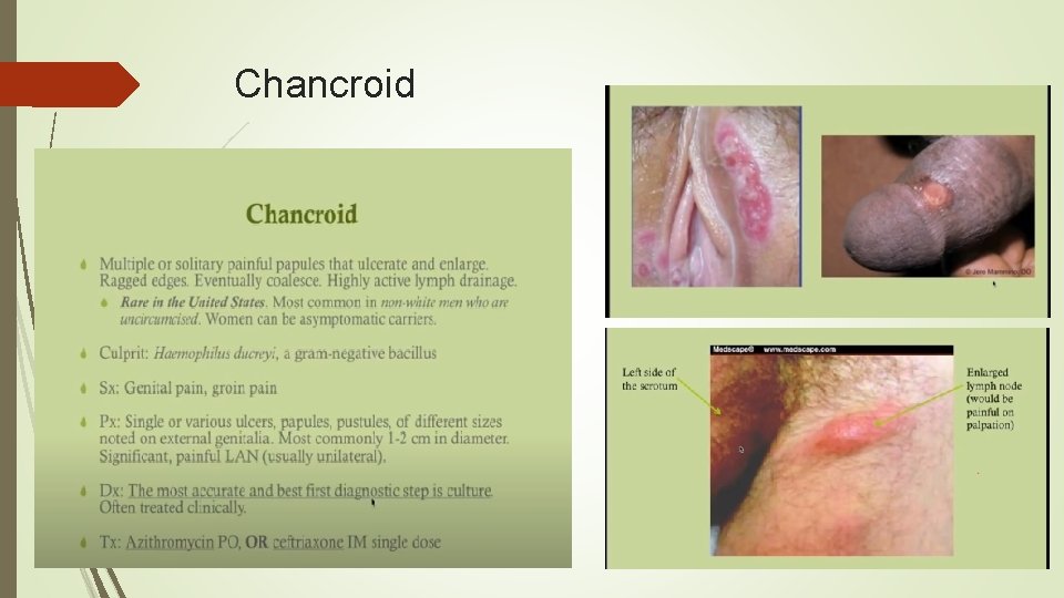 Chancroid 