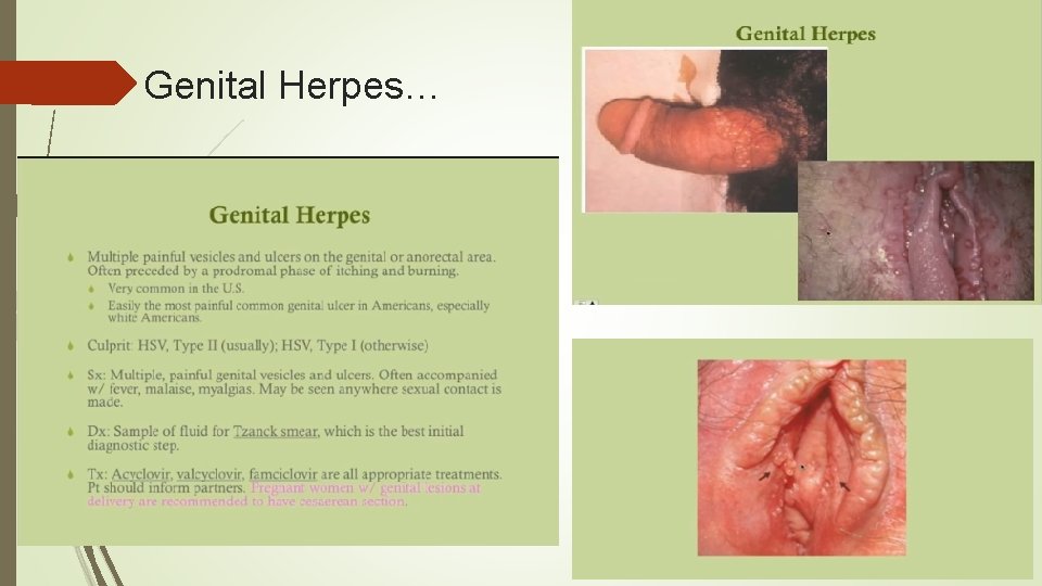 Genital Herpes… 