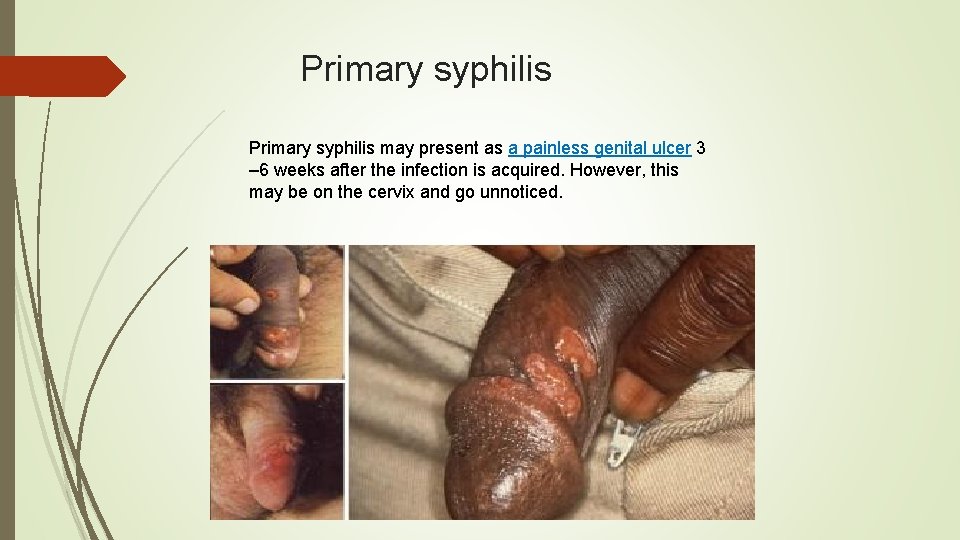 Primary syphilis may present as a painless genital ulcer 3 – 6 weeks after