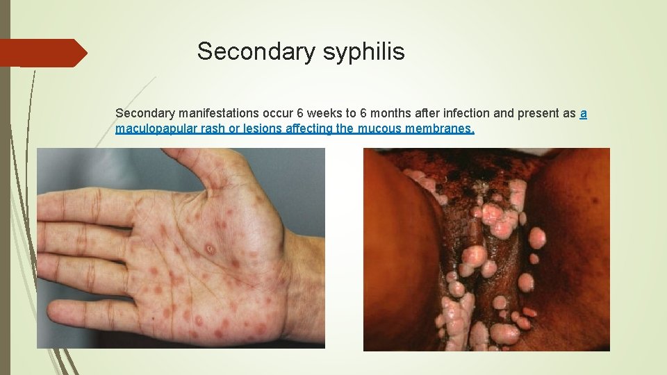 Secondary syphilis Secondary manifestations occur 6 weeks to 6 months after infection and present