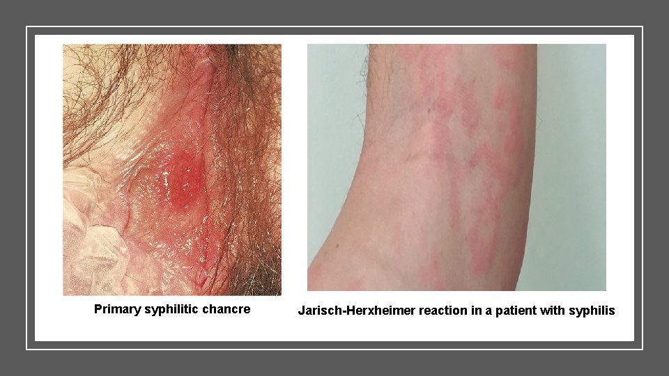 Primary syphilitic chancre Jarisch-Herxheimer reaction in a patient with syphilis 