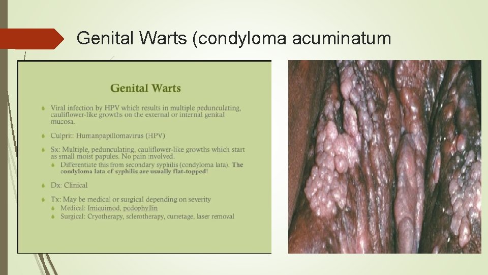 Genital Warts (condyloma acuminatum 