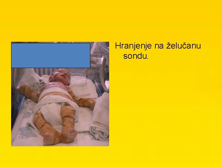 Hranjenje na želučanu sondu. 