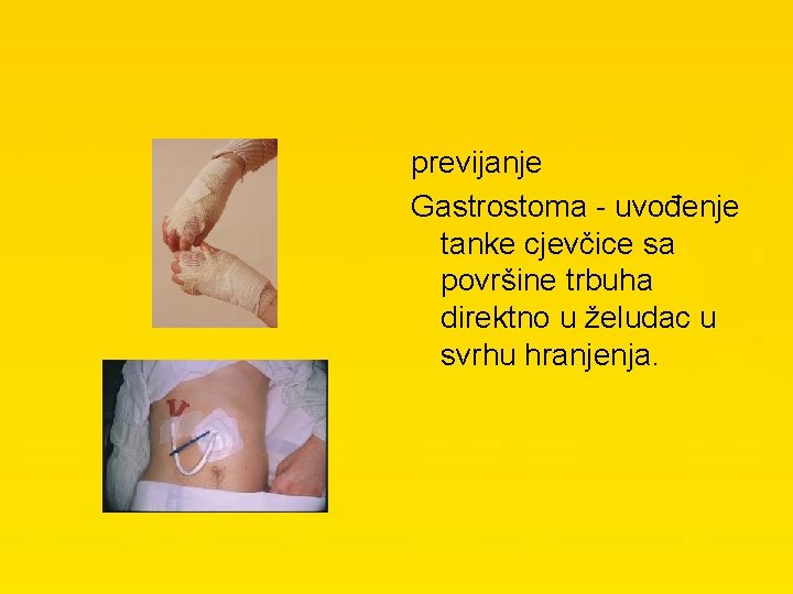 previjanje Gastrostoma - uvođenje tanke cjevčice sa površine trbuha direktno u želudac u svrhu