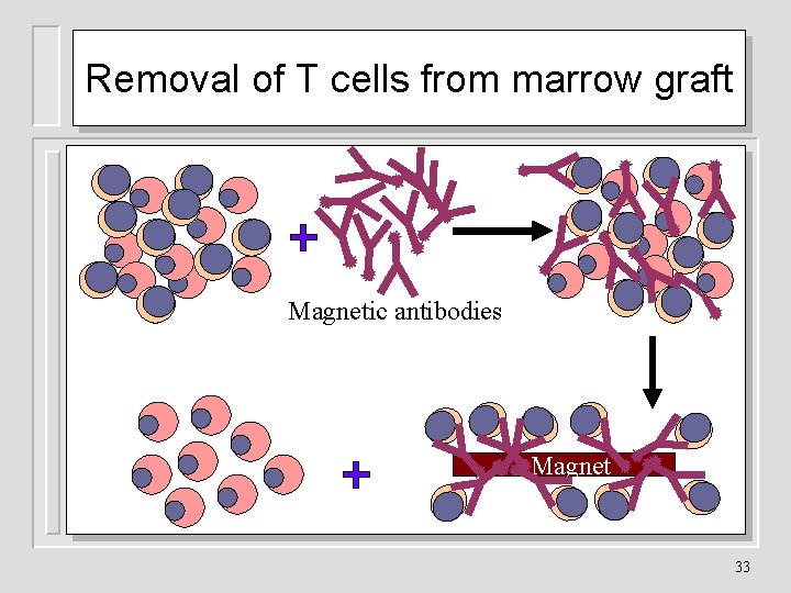 Removal of T cells from marrow graft Magnetic antibodies Magnet 33 
