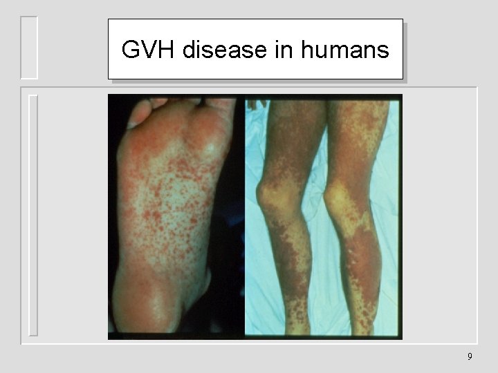 GVH disease in humans 9 