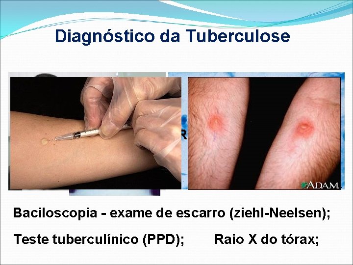 Diagnóstico da Tuberculose Raio X do tórax; Baciloscopia - exame de escarro (ziehl-Neelsen); Teste
