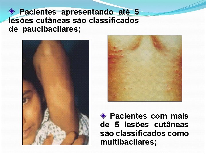 Pacientes apresentando até 5 lesões cutâneas são classificados de paucibacilares; Pacientes com mais de