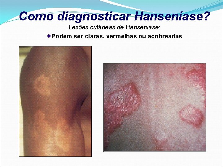 Como diagnosticar Hanseníase? Lesões cutâneas de Hanseníase: Podem ser claras, vermelhas ou acobreadas 