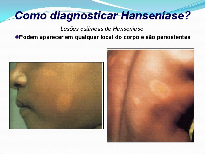 Como diagnosticar Hanseníase? Lesões cutâneas de Hanseníase: Podem aparecer em qualquer local do corpo