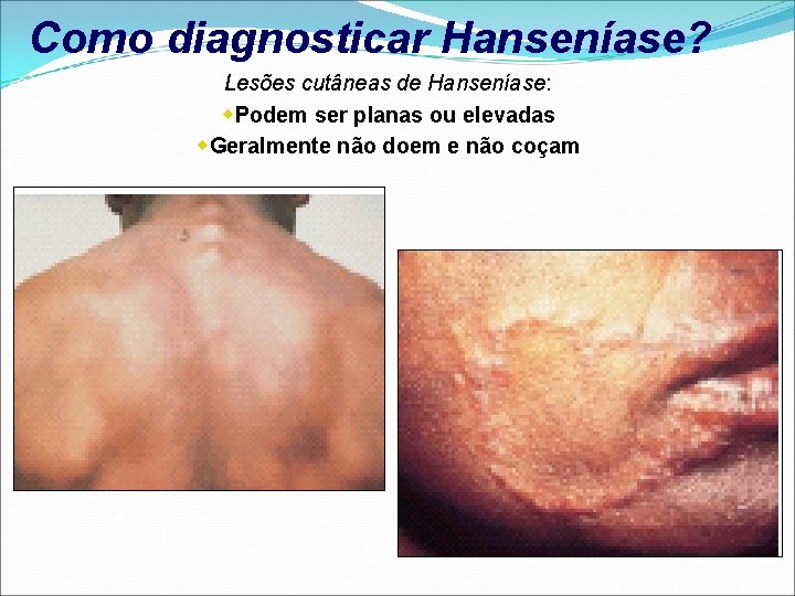 Como diagnosticar Hanseníase? Lesões cutâneas de Hanseníase: w. Podem ser planas ou elevadas w.