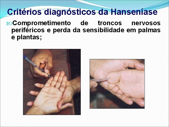 Critérios diagnósticos da Hanseníase Comprometimento de troncos nervosos periféricos e perda da sensibilidade em