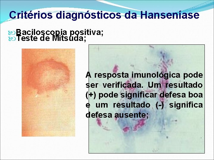 Critérios diagnósticos da Hanseníase Baciloscopia positiva; Teste de Mitsuda; A resposta imunológica pode ser