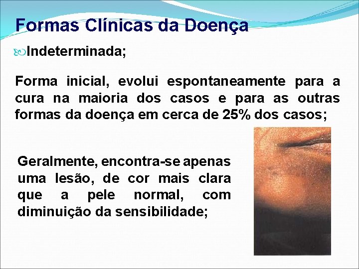 Formas Clínicas da Doença Indeterminada; Forma inicial, evolui espontaneamente para a cura na maioria