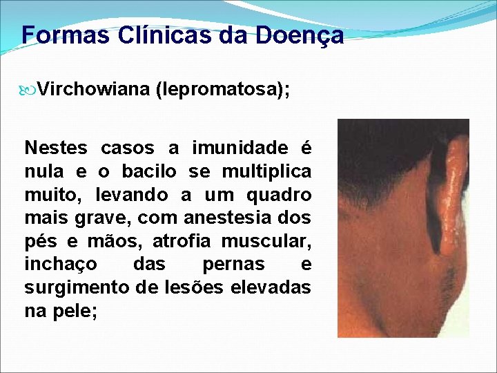 Formas Clínicas da Doença Virchowiana (lepromatosa); Nestes casos a imunidade é nula e o