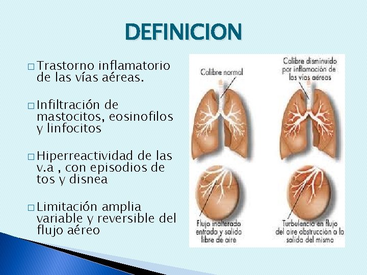 DEFINICION � Trastorno inflamatorio de las vías aéreas. � Infiltración de mastocitos, eosinofilos y