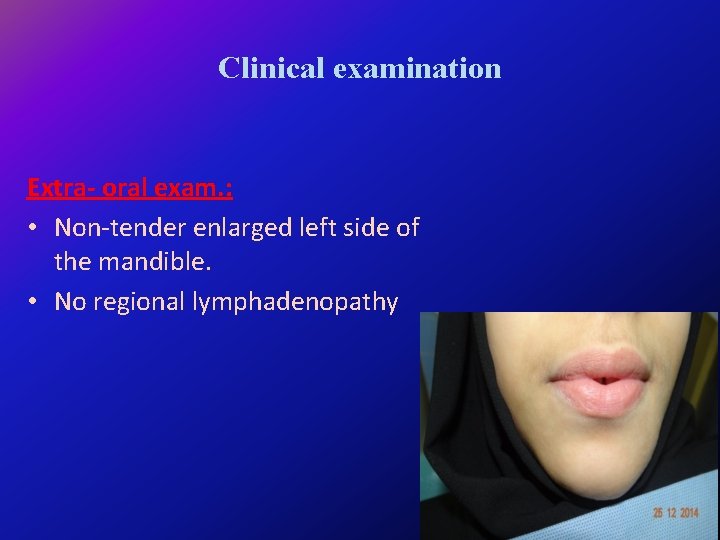 Clinical examination Extra- oral exam. : • Non-tender enlarged left side of the mandible.