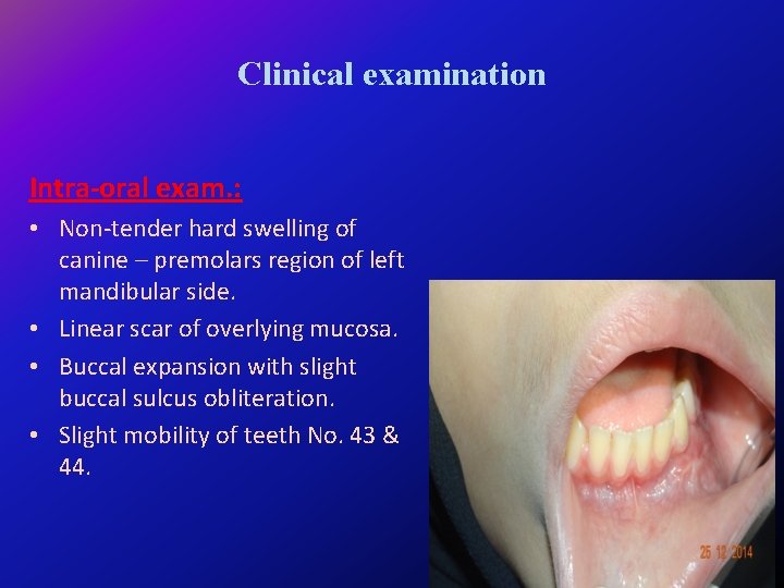 Clinical examination Intra-oral exam. : • Non-tender hard swelling of canine – premolars region