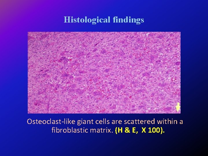 Histological findings Osteoclast-like giant cells are scattered within a fibroblastic matrix. (H & E,