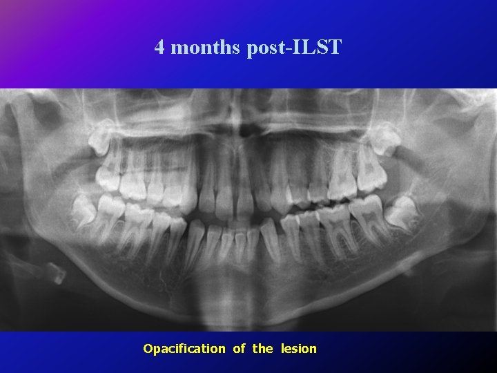 4 months post-ILST Opacification of the lesion 