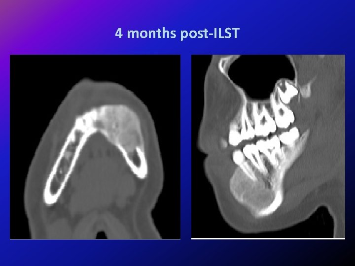 4 months post-ILST 