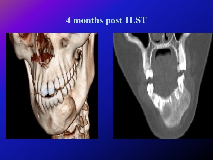 4 months post-ILST 