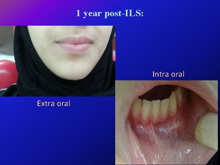 1 year post-ILS: Intra oral Extra oral 