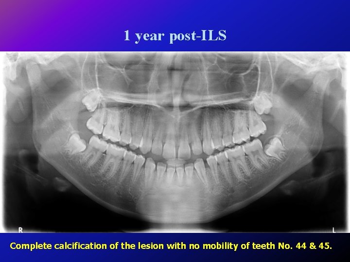 1 year post-ILS Complete calcification of the lesion with no mobility of teeth No.