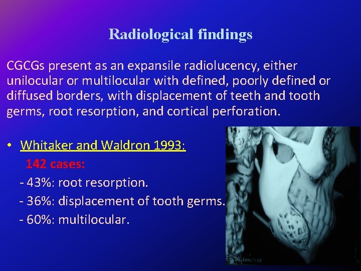 Radiological findings CGCGs present as an expansile radiolucency, either unilocular or multilocular with defined,