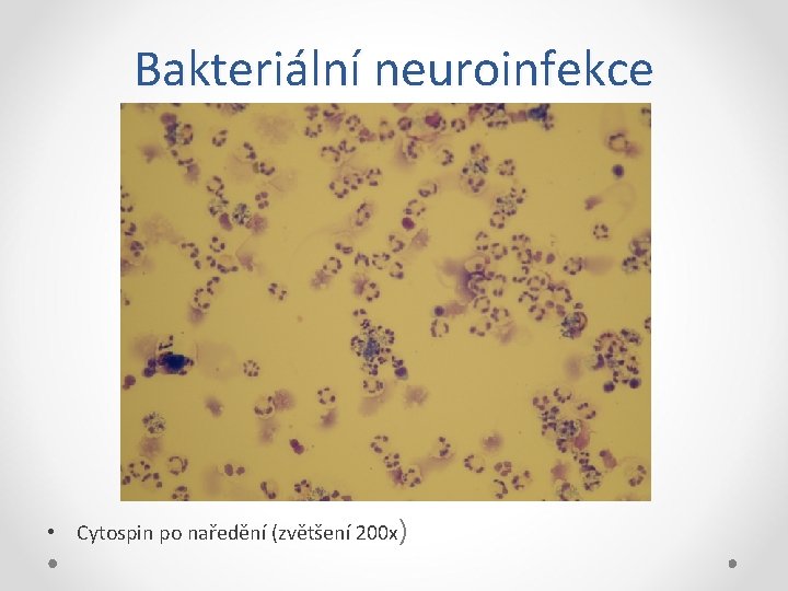 Bakteriální neuroinfekce • Cytospin po naředění (zvětšení 200 x) 